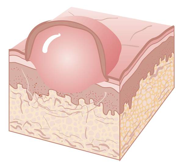 <p><span style="line-height: inherit; font-size: inherit;">&nbsp;large vesicle greater than 0.5 cm</span></p><p></p>