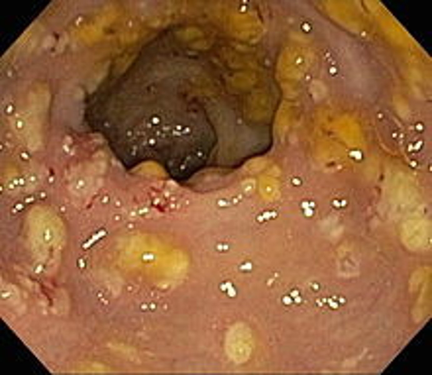 <p>bacterium that can cause serious complications such as colitis and highly resistant to antibiotics</p>