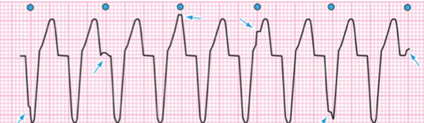 <p>- may be perfusing rhythm (pulse) or non-perfusing (pulseless)</p><p>- rate: >100 bpm</p><p>- regular rhythm with no P waves and wide QRS</p><p>*looks like McDonald's arch: Mac attack = Vtach</p>