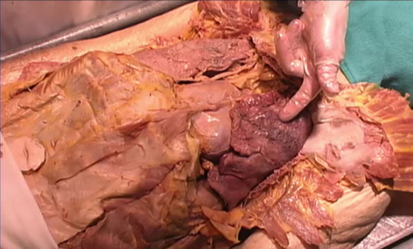 <p>What is the structure being pointed to in this image?</p><p>clavicle</p><p>sternum</p><p>heart</p><p>lung</p>