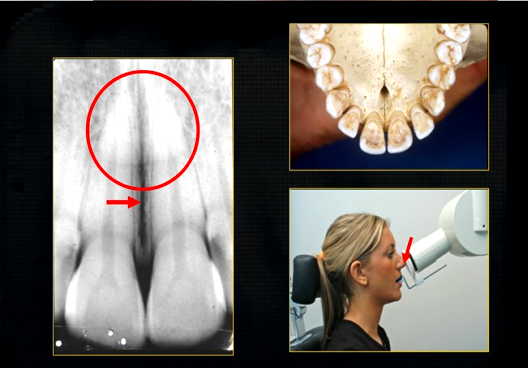 <p>this increased radiopacity is caused by the <strong>soft tissues at the tip of the nose - shadow - dense tissue </strong></p>
