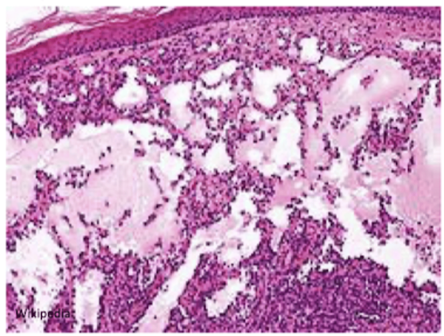 <p>network of endothelium lined channels w/ no RBC's</p><p>head, neck, axilla</p>