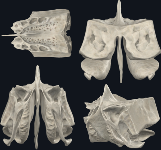 <p>Parte anterior y media de la base del cráneo</p><p>Hueso irregular e impar</p><p>Forma parte de las fosas nasales, cavidades orbitarias y craneal</p><p>Cuboideo</p><ul><li><p>Muy ligero debido a las cavidades neumáticas que lo conforman (celdillas etmoidales)</p></li><li><p>Lo más externo de las fosas nasales</p></li></ul><p></p><ul><li><p><strong>Parte del Neurocráneo</strong></p></li><li><p><strong>osificación endocondral</strong>.</p></li></ul><p></p>