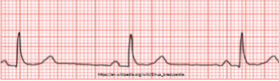 <p><u>In Sinus Bradycardia</u></p><ul><li><p>Rate is slower than __ bpm</p></li><li><p>QRS is __, ST is __ , T-wave is __</p></li></ul><p></p>