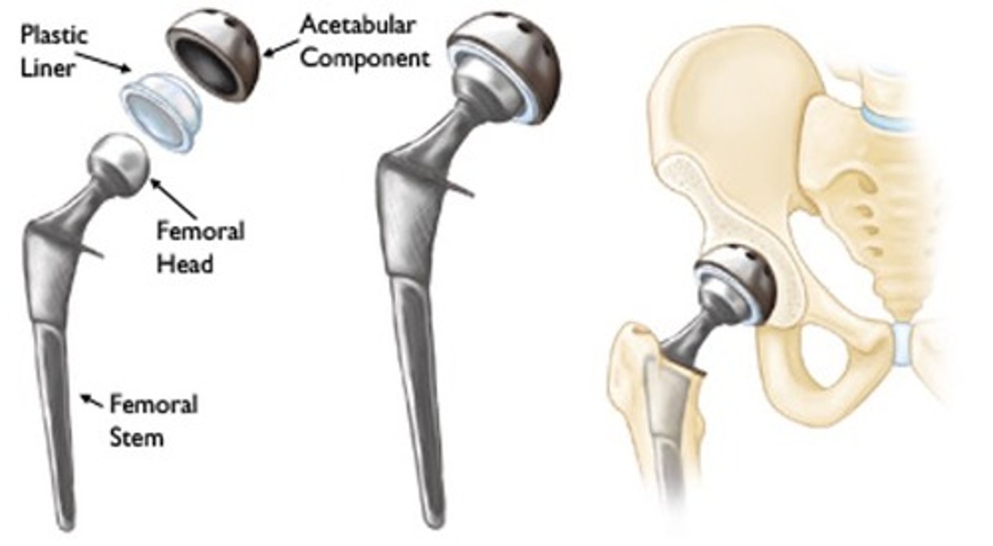 <p>Surgery to restore a damaged hip to full function. During the surgery, a plastic lining is fitted into the acetabulum to restore a smooth surface. The head of the femur is removed and replaced with a metal ball attached to a metal shaft that is fitted into the femur</p>