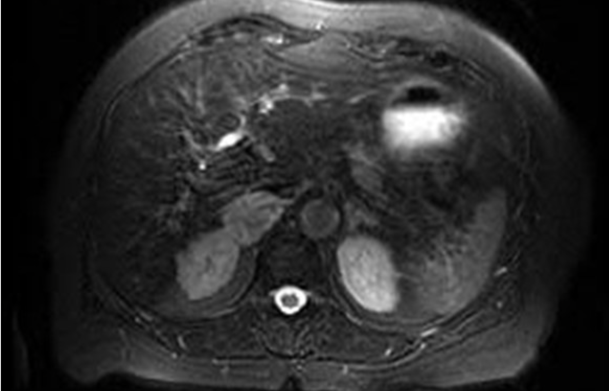 <p><span>Asymptomatic woman who underwent a right partial nephrectomy for a grade 2 pT1b clear cell RCC has an MRI scan with <strong>T2 shown</strong> and and <strong>out-of-phase sequence images without signal drop-out</strong>. What do we think is going on?</span></p>