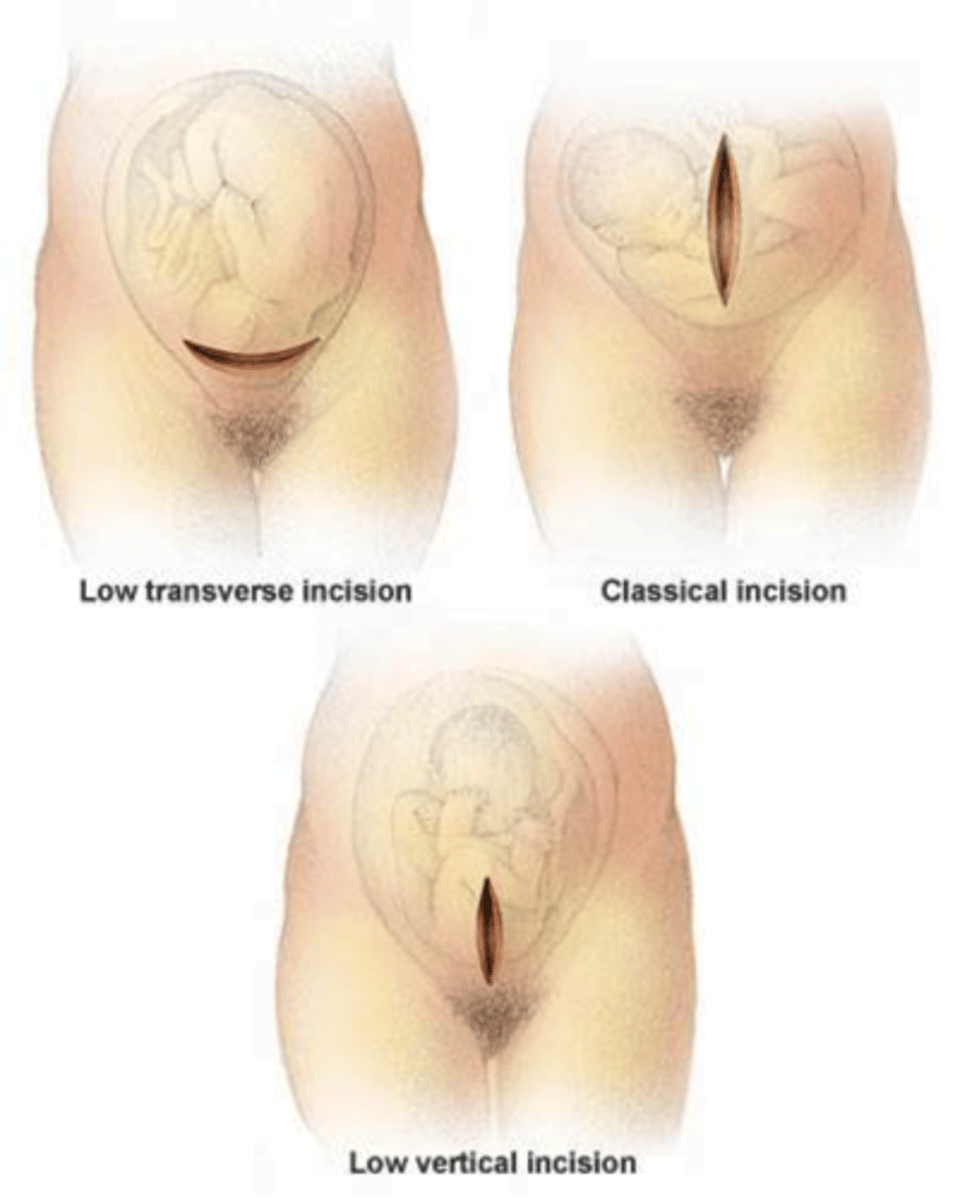 <p>the birth of a baby through an incision in the mother's abdomen and uterus</p>