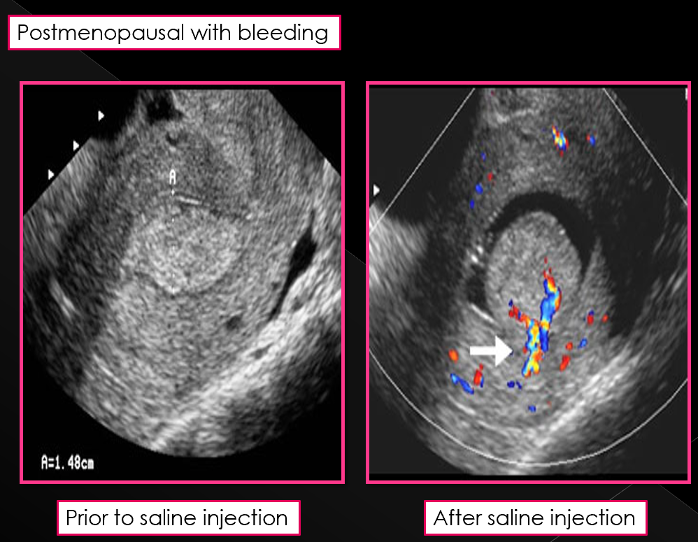 <p>Sonohysterography is NOT performed in women with acute _____</p>