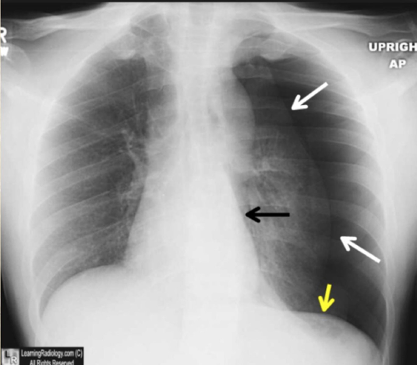 <p>What does this CXR show?</p>