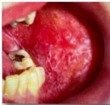 <p>FORM OF LICHEN PLANUS&nbsp;</p>