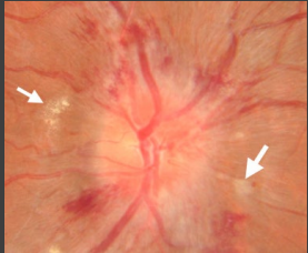 <p><strong>Fundoscopic Exam</strong></p><p>-Visual inspection of _______, vessels, and optic disc</p><p>-Papilledema/optic disc edema indicates ___________ ICP</p><p>-Look for sharp optic _____ margins, smoothness of vessels, observe the ______ of the disc and look for hemorrhages and exudate</p><p>-Differential diagnosis → idiopathic intracranial ___________, venous thrombosis, intracranial mass lesion, hydrocephalus, __________, and optic neuritis</p>