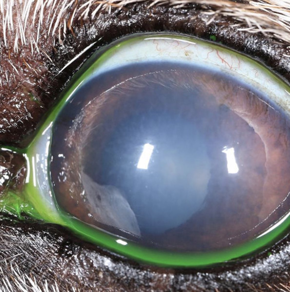 <p>What are 5 causes of focal corneal edema?</p>
