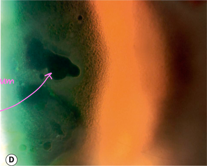<ul><li><p>swelling of cornea</p></li><li><p><span>Will present as small epithelial vesicles</span></p></li><li><p><span>seen w/ endothelial compromise</span></p></li></ul><p></p>
