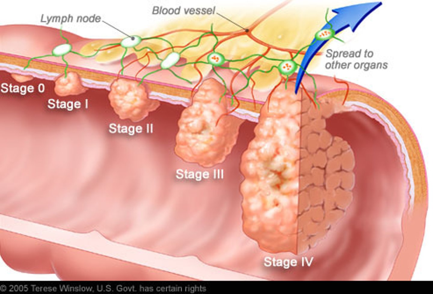 <p>- Hematochezia—blood in stool</p><p>- Iron deficiency anemia w/ fatigue— ↓ HgB, Hematocrit</p><p>- Tenesmus—persistent, uncomfortable feeling of needing to have a bowel movement</p><p>- Fecal Urgency</p><p>- ⦸ stool or gas beyond hepatic flexure</p>