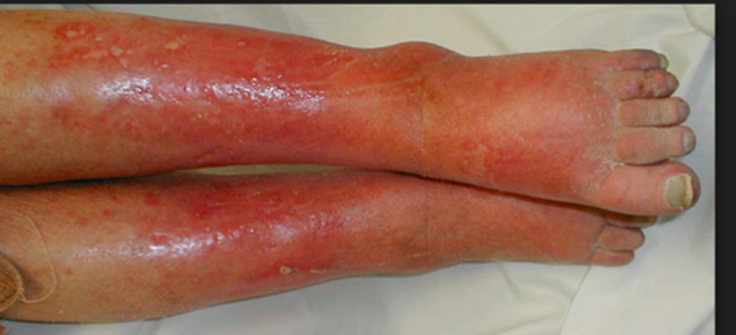 <p>one of the 4 cardinal sings of inflammation, defined as redness</p>