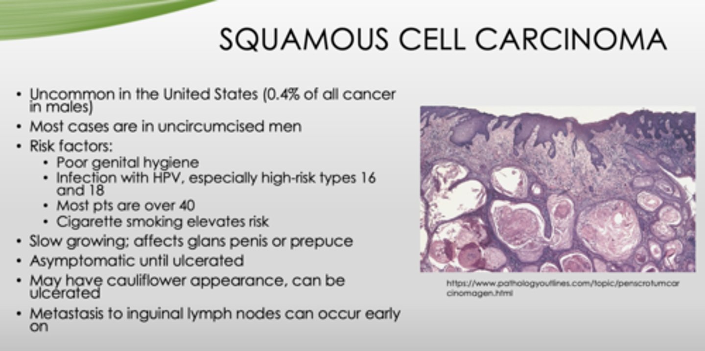 <p>squamous cell carcinoma</p>
