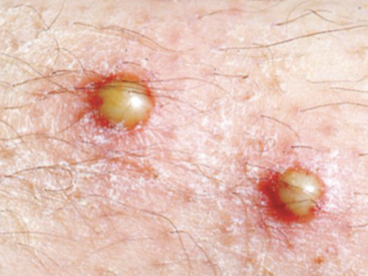 <p>circumscribed superficial cavity of skin that contains a purulent exudate which may be yellow</p>