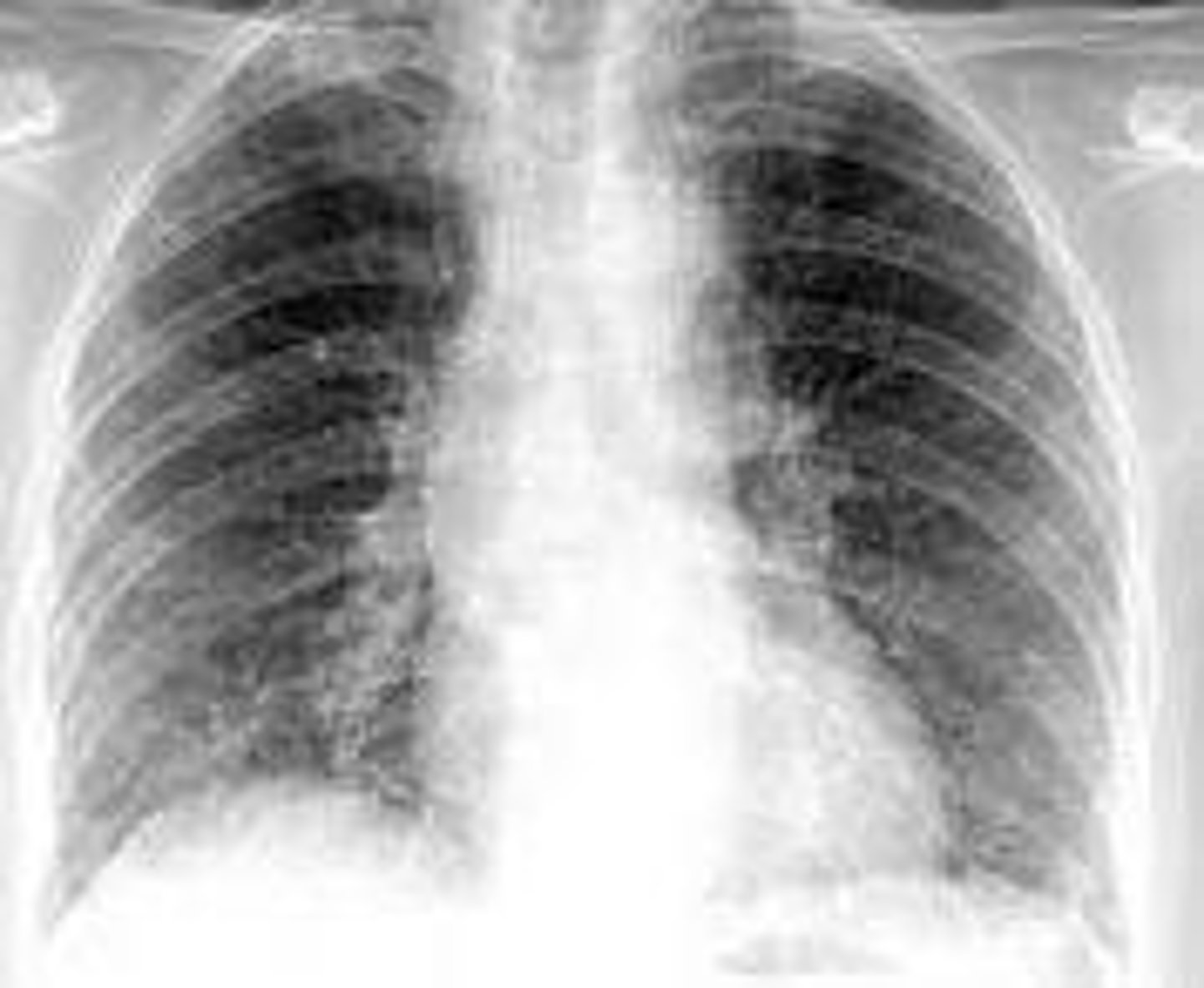 <p>______ is an acute condition in which the lungs become inflamed and filled with fluid,</p>