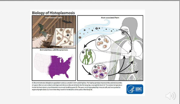 <p><span><span>What is the prognosis of untreated disseminated histoplasmosis?</span></span></p>