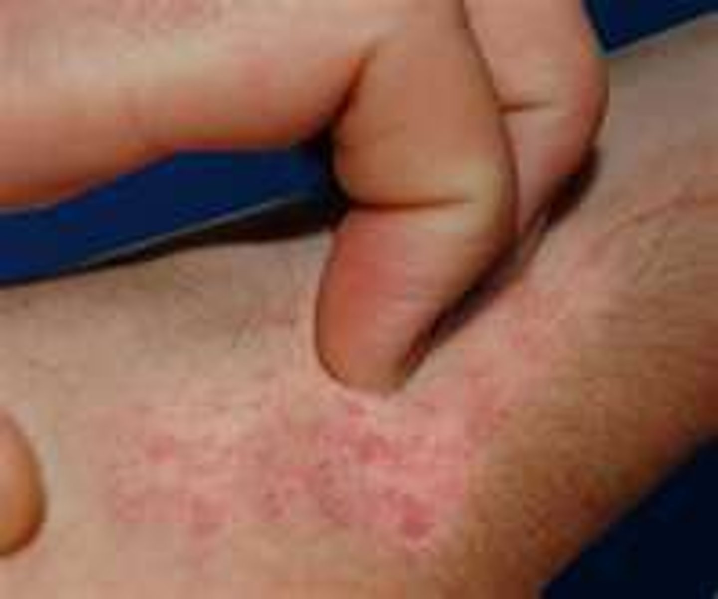 <p>Pruritus</p>