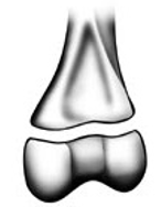 <p>Grade the Salter-Harris fracture?</p>