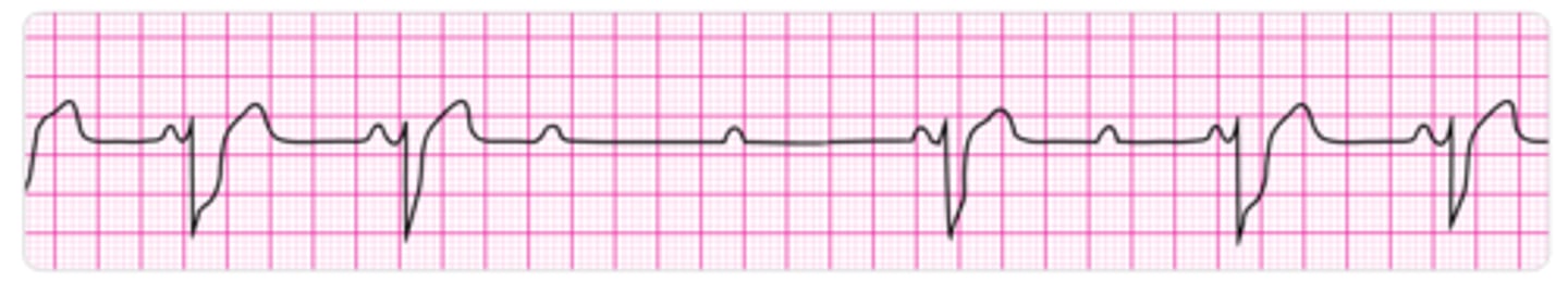 <p>Dropped QRS complexes with consistent PR intervals (no progressive lengthening as seen in Mobitz Type I)</p>