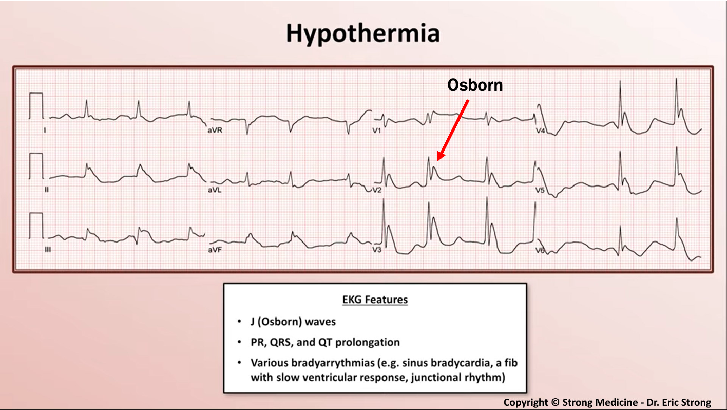 <p>35C- sinus bradycardia followed by prolongation of intervals; below 32C- Osborn waves commonly mistaken for STEMIs</p><p>(changes in ECG due to acidosis not temperature)</p>