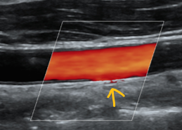 <ul><li><p>type of noise artifact</p></li><li><p>caused by tissue, heart wall, valve, or vessel wall motion</p></li></ul>