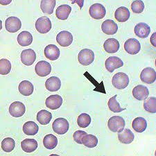 <p>Identify this type of red cell.</p>