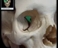 <p>Posterior part of roof of orbit Upper boundary of superior orbital fissure Has orbital opening of optic canal Optic canal transmits optic nerve and ophthalmic artery</p>