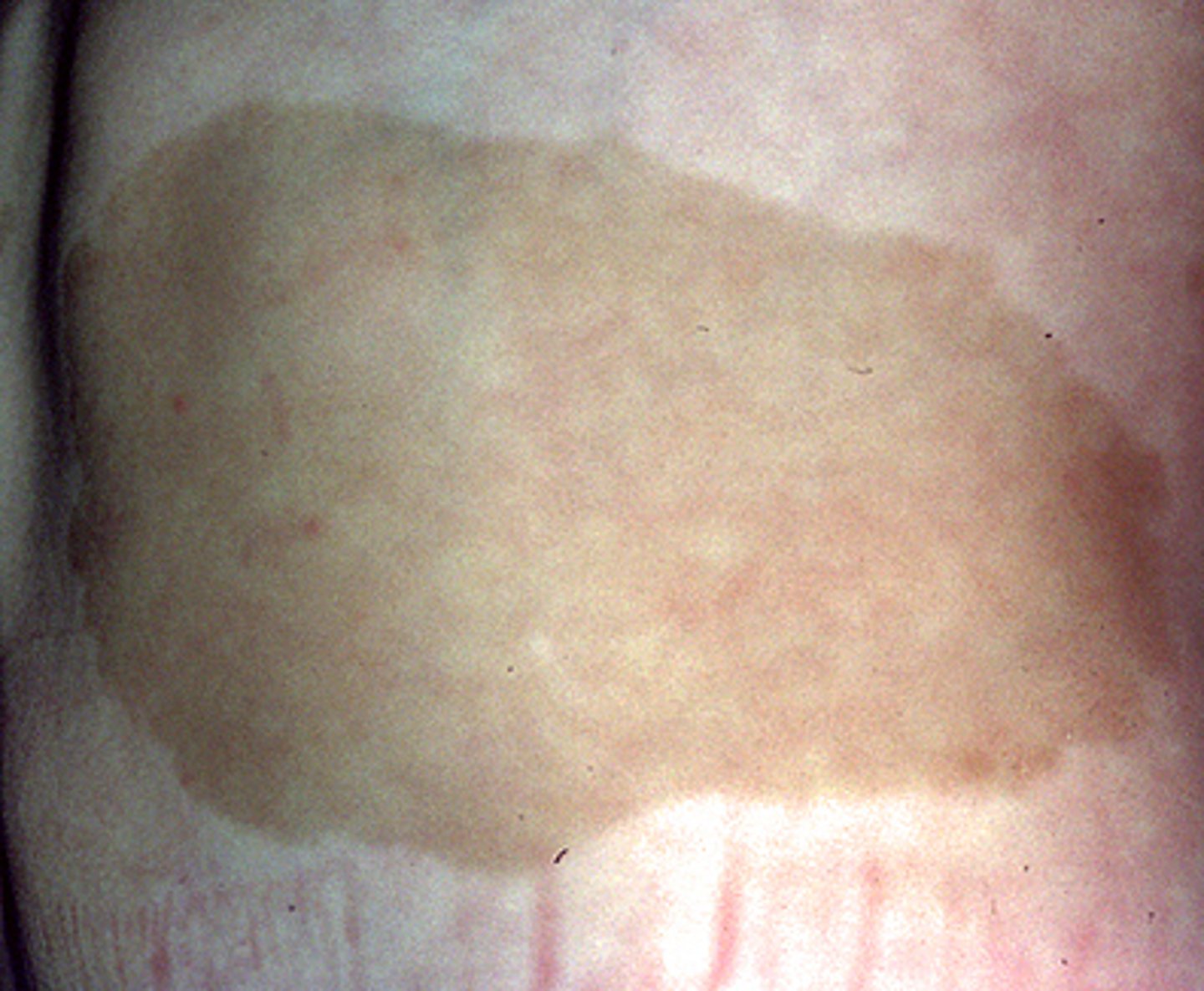 <p>Café-au-lait macules (CALM) are flat pigmented lesions that may be present at birth or appear during early ϲhilԁhooԁ, often first becoming noticeable following sun exposure (picture 3A-C). They represent localized areas of increased melanogenesis, the etiology of which is not known except when associated with conditions such as McCune-Albright syndrome</p><p>If desired for cosmetic reasons, CALM can be treated with pigment-specific lasers, such as the quality-switched (Q-switched) ruby, Q-switched alexandrite, and Q-switched neodymium:yttrium aluminum garnet (Nd:YAG) lasers; nonablative fractional 1550 nm erbium-doped fiber laser; and alexandrite picosecond laser. However, multiple treatment sessions are usually required, responses are variable, recurrences are common, and there is a risk of side effects, such as persistent hyperpigmentation or hypopigmentation.</p>