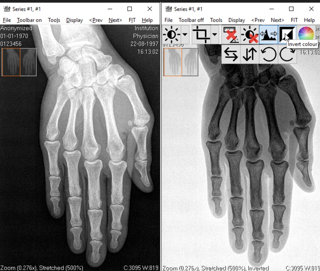 <p>When is the inversion of gray scale tool used in radiograph processing?</p>