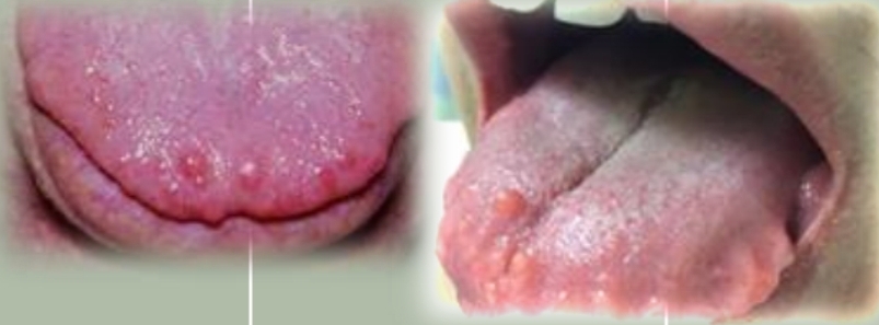 <p>Multiple pink papules and nodules, soft and nontender. Marfanoid body type (disproportionately long limbs, fingers toes). Narrow face, full lips.</p><p>First decade</p><p>No gender bias</p><p class="has-focus"><strong>Found on:</strong></p><p class="has-focus">Labial and buccal mucosa</p><p class="has-focus">Anterior tongue</p><p class="has-focus">Gingiva</p><p class="has-focus">Conjunctiva and eyelids</p>