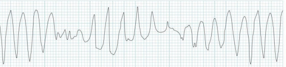 <p>What does this EKG show?</p>