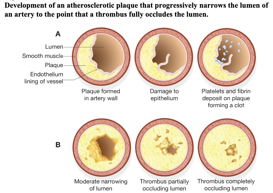 <p>blood clot w/in a blood vessel, may partially or completely occlude blood vessel; or a hard collection of fibrin, blood cells, and tissue debris that is the result of the blood-clotting process (ch.5,6 - signs and symptoms)</p>