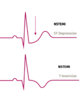 <p><u>NSTEMI</u></p><ul><li><p>Suspected cardiac __ injury from elevated __ (protein)</p></li><li><p>Instead of ST elevations, commonly seen are ST __ or T-wave __</p></li></ul><p></p>
