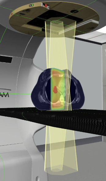 <p>Describe this treatment technique</p>