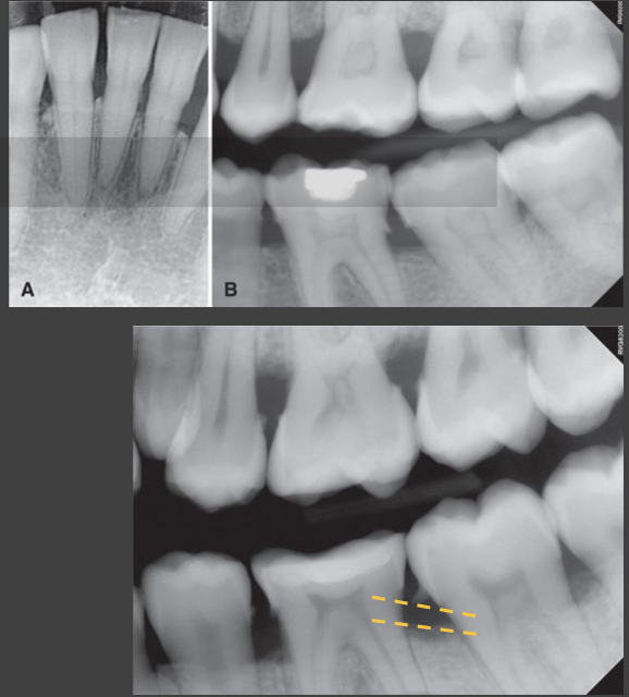 <ul><li><p>Loss in height of alveolar process</p><ul><li><p>Crest of buccal/lingual cortical plates and intervening interdental bone resorbed</p></li><li><p>Crest parallels imaginary line joining CEJs of adjacent teeth</p></li></ul></li><li><p>Severity based on bone level relative to root length (distance between CEJ and apex)</p><ul><li><p>Within coronal 15%</p></li><li><p>Within coronal 15%–33% of root</p></li><li><p>Beyond (apical to) coronal 33% of root length</p></li></ul></li><li><p>When CEJs of adjacent teeth are at different levels, crest may appear angled</p></li><li><p>When teeth supraerupt, bone may not follow → apical position of crest relative to CEJ</p><ul><li><p>May occur during passive eruption of severely attrited teeth</p></li><li><p>Bone loss not caused by periodontitis</p></li></ul></li><li><p>Bone loss at a single exam does not indicate current disease activity</p><ul><li><p>Reestablishment of crestal cortication is good indicator of stabilization</p></li></ul></li></ul><p></p>