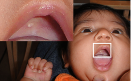 <ul><li><p>small white papule seen in the midline of the palate of an infant</p></li><li><p>represents epithelial tissue that becomes trapped during palatal fusion</p></li></ul><p></p>