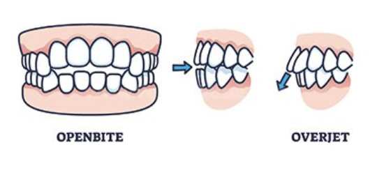 <p>Open bite → max anterior teeth protrude labially </p>