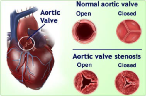 <p>scar tissue forms around aortic valve </p>