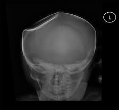 <p>fragment driven inward, e.g., skull fragment pushed into brain</p>