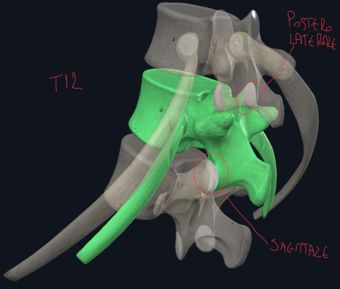 <p>Quando arriviamo al livello di T11 e T12, il tubercolo costale non si articola più con il processo trasverso vertebrale → da qui il nome vertebre fluttuanti.</p><p>Mancano quindi le tipiche articolazioni costo-trasversarie presenti da T1 a T10.</p><p>Le faccette superiori di T12 mantengono un orientamento toracico posterolaterale, permettendo ancora rotazione, mentre a partire da quelle T12 inferiori, viene assunto un orientamento sagittale tipico delle vertebre lombali → T12 si articola quindi con L1 per consentire flessione ed estensione.</p><p>Questa brusca transizione, rende T12 il punto più vulnerabile della colonna toracica.</p>