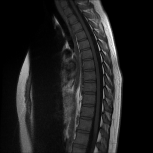 <p>Why is there a saturation band on this thoracic spine image?</p>