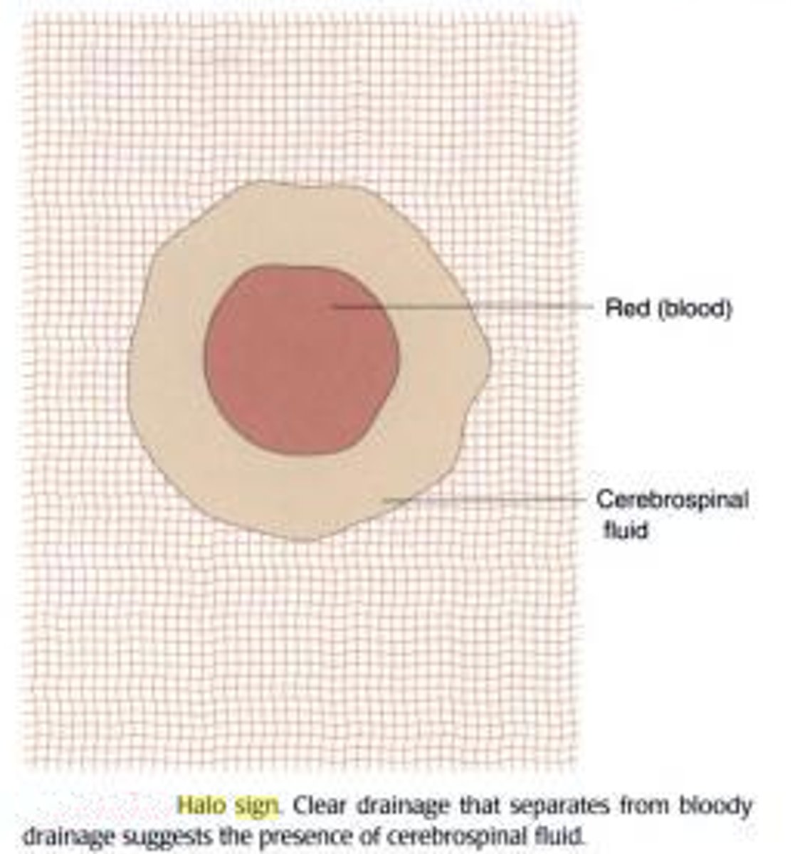 <p>blood tinged drainage w/ yellow ring around it</p>