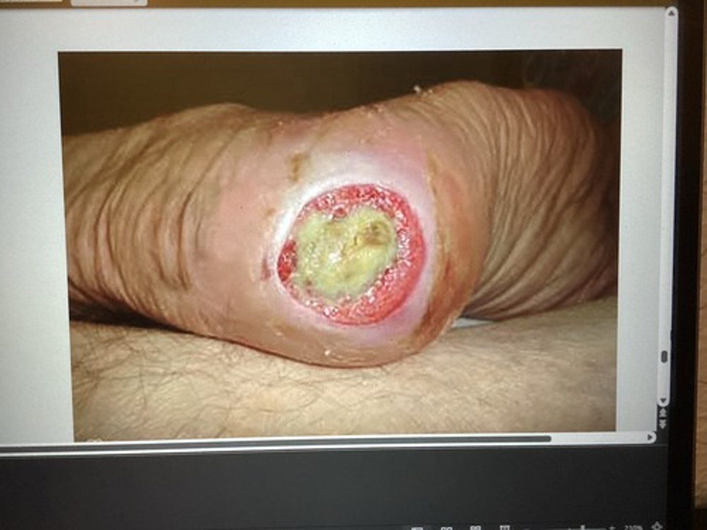 <p>stage 3</p><p>Debridement can promote granulation &amp; contraction. (Epithelialization)</p>