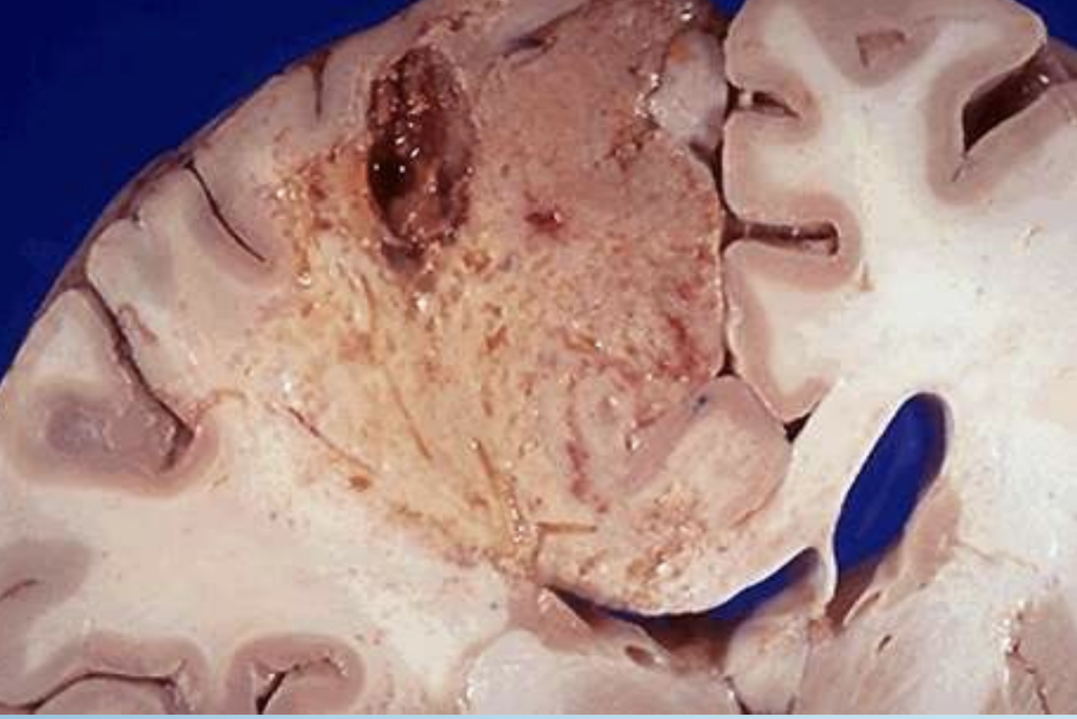 <p>Liquefactive Necrosis</p>