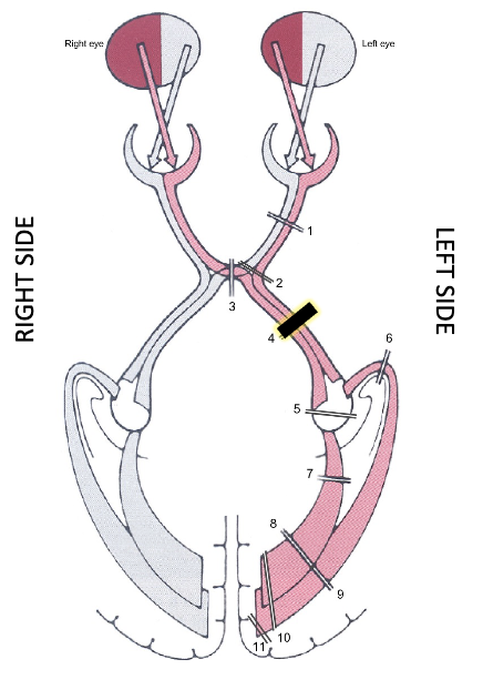 <p>what is it? what does it result in?</p>