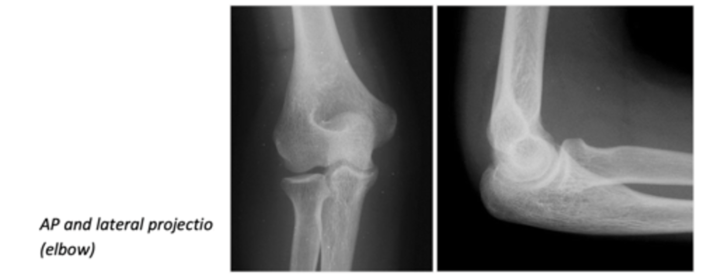 <p>The elbow is studied using AP (anteroposterior) and lateral projections.</p>