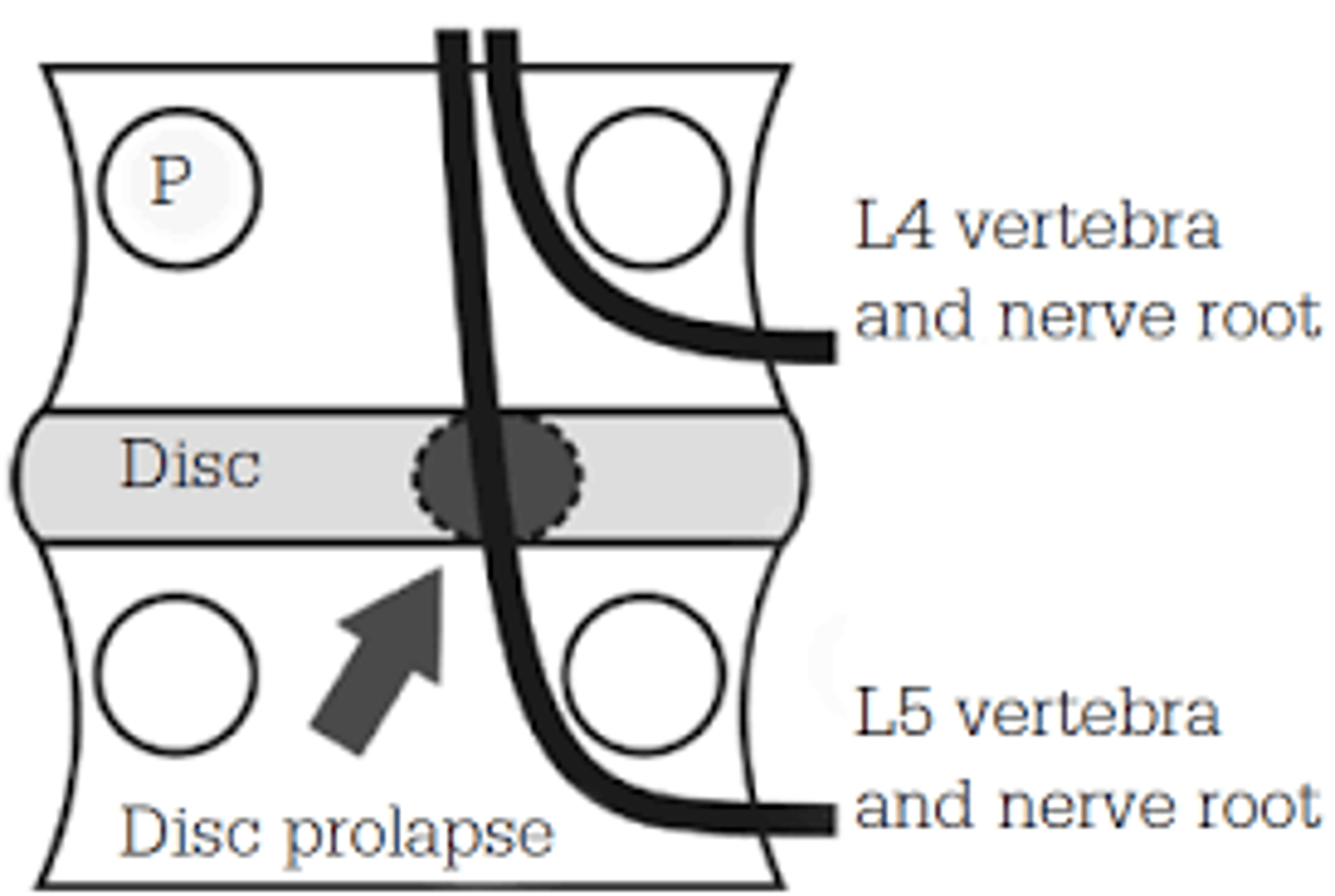 <p>In the lumbar spine, is the exiting root or the traversing root more likely to be impacted?</p>